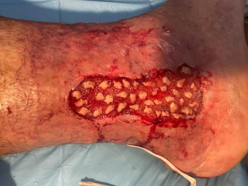Profesionales de Enfermería se forman en el tratamiento de heridas crónicas complejas con el uso de microinjertos de epidermis en sello