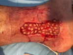 Profesionales de Enfermería se forman en el tratamiento de heridas crónicas complejas con el uso de microinjertos de epidermis en sello